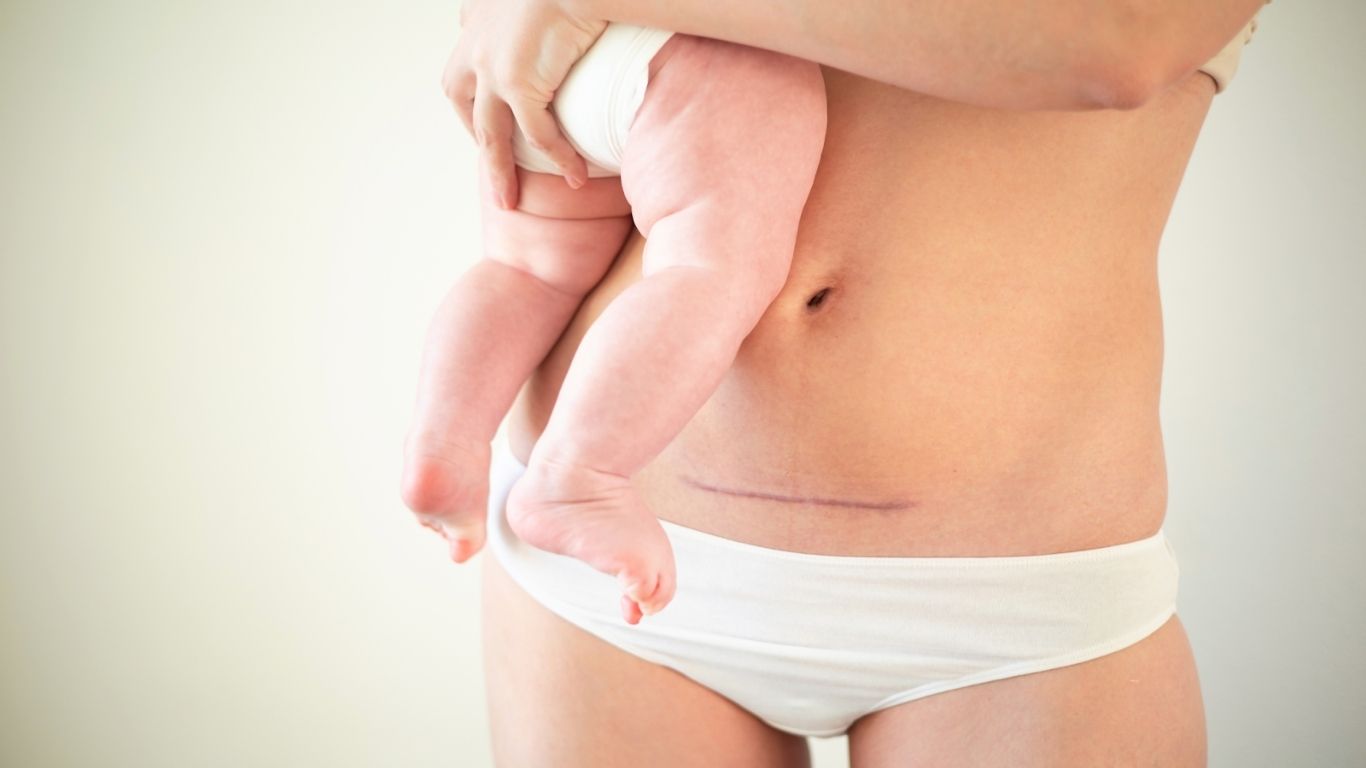 Tu nueva cicatriz y tú: Guía para la recuperación postcesárea